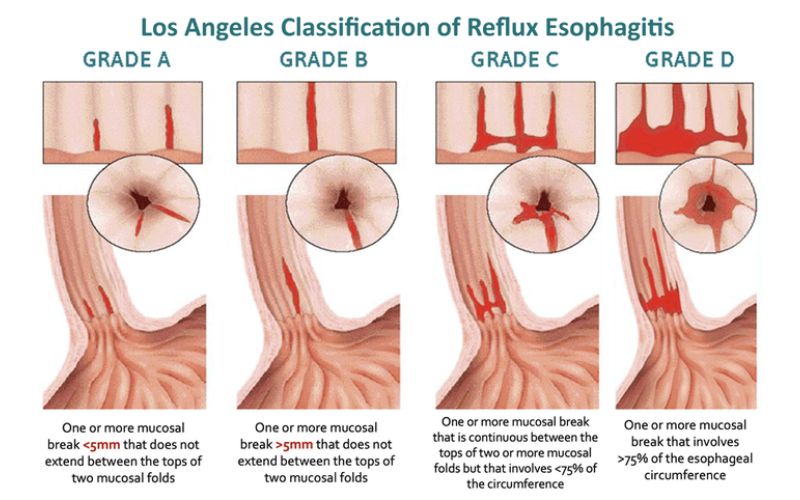 Phân độ trào ngược thực quản GERD 