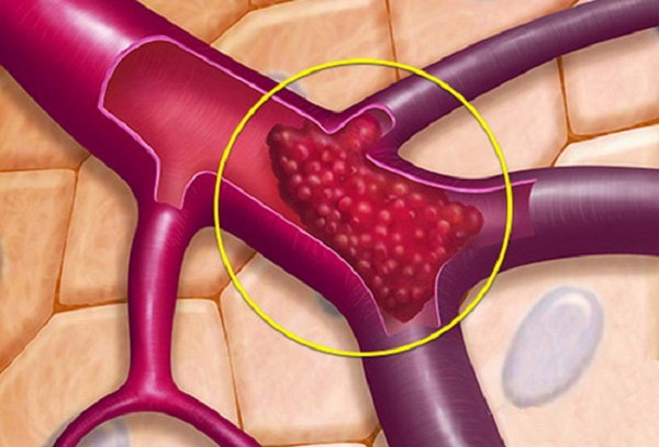 Phân loại các dạng đột quỵ và tìm hiểu nguyên nhân