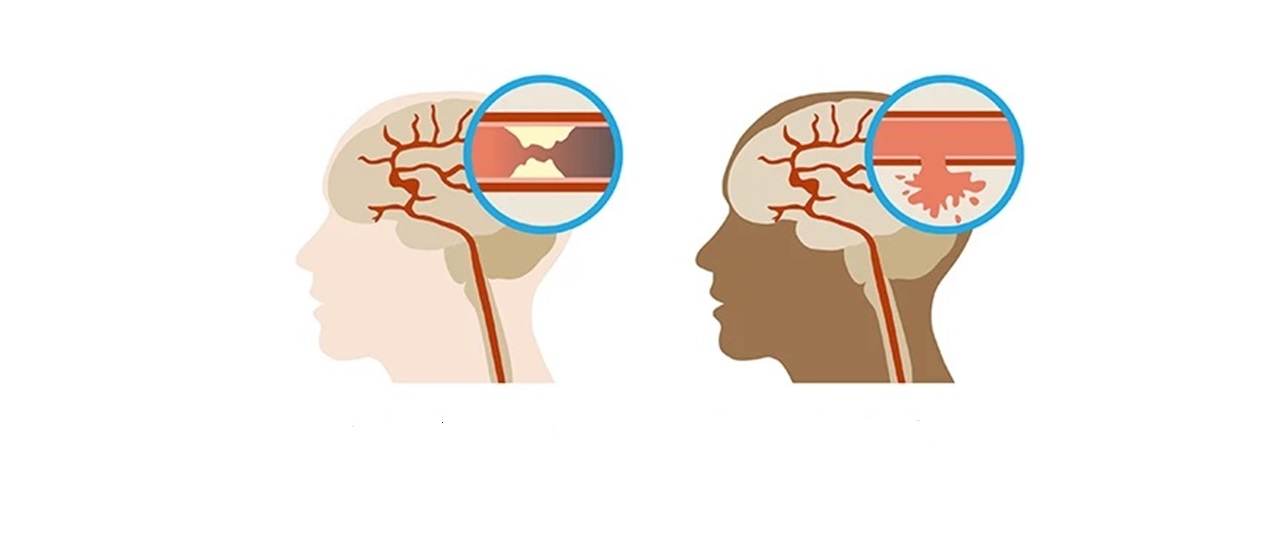 Phân loại đột quỵ não và cách phòng tránh