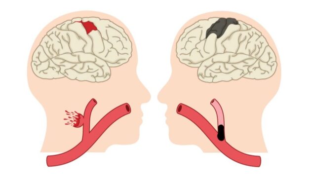 Phân loại đột quỵ não và cách phòng tránh