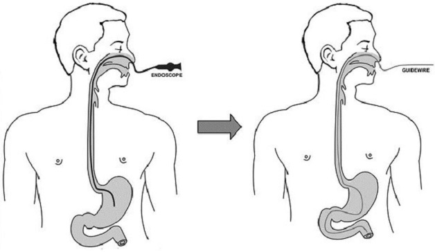 Phân loại nội soi tiêu hóa bằng ống soi mềm và lưu ý