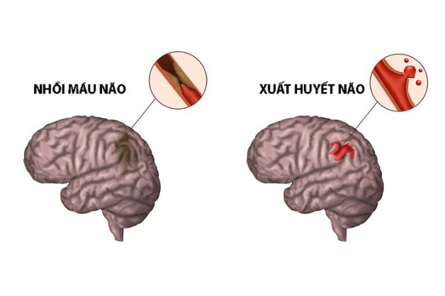 Phân loại tai biến mạch máu não và triệu chứng nhận biết