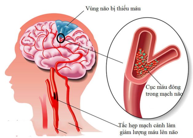 Phân loại và nhận biết dấu hiệu các dạng đột quỵ