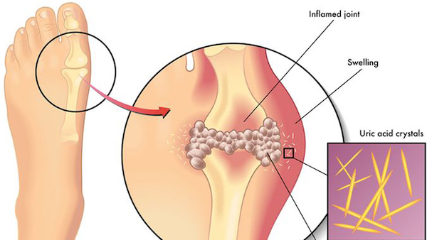 Phát hiện bị tăng axit uric nhờ đi kiểm tra sức khoẻ định kỳ