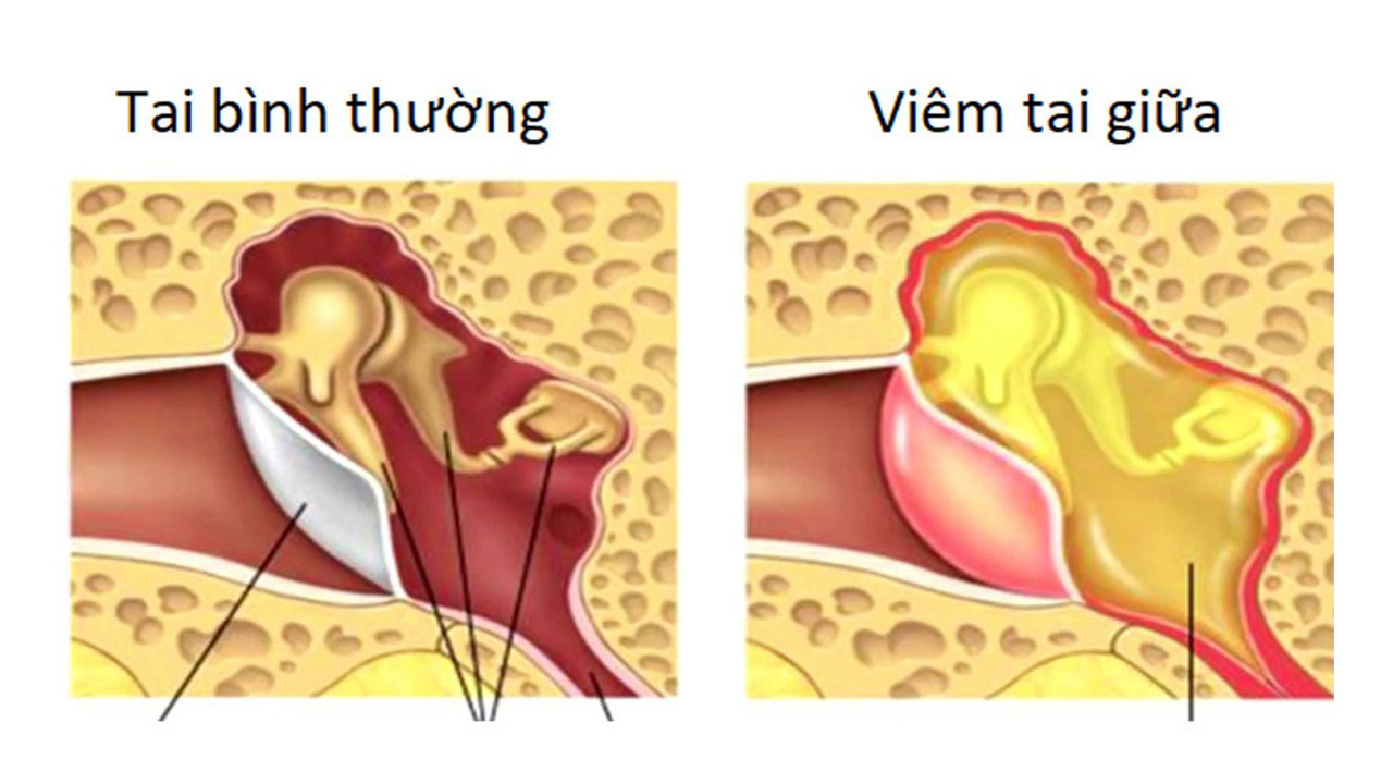 Phát hiện nhanh tình trạng viêm tai giữa người lớn và cách điều trị