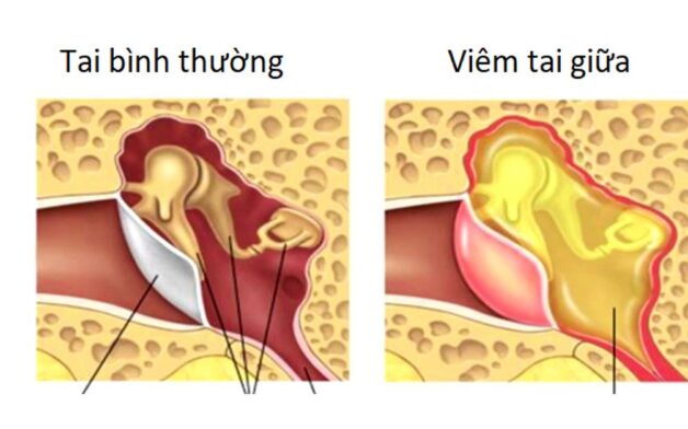 Phát hiện nhanh tình trạng viêm tai giữa người lớn và cách điều trị