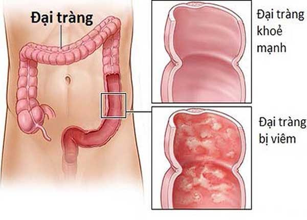 Phát hiện sớm khối u đại tràng nhờ nội soi đường tiêu hóa