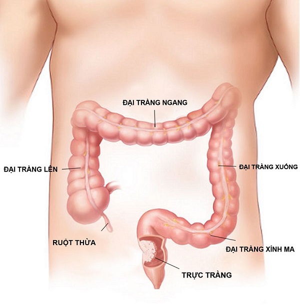 Phát hiện sớm ung thư trực tràng