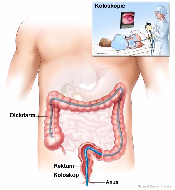 Phát hiện sớm ung thư trực tràng