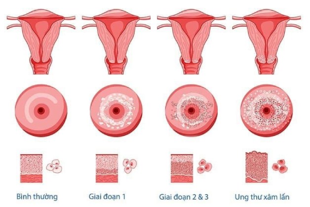 Phát hiện ung thư cổ tử cung sớm giúp điều trị khỏi bệnh tới 90%