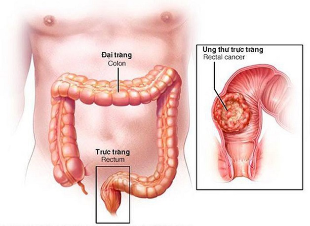 Phát hiện ung thư đại tràng bằng cách nào?