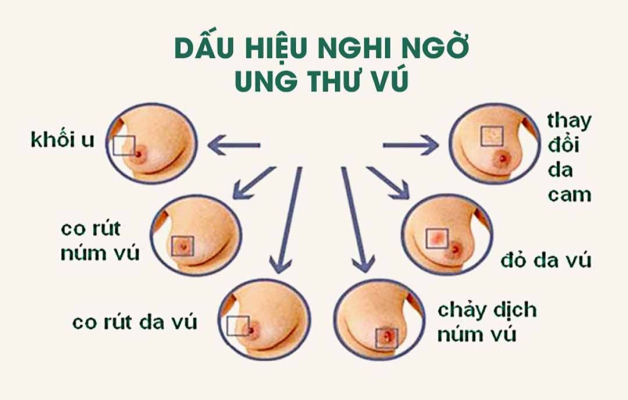 Phát hiện ung thư vú sớm bằng cách nào? 