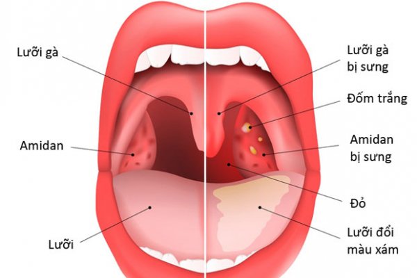 Phẫu thuật cắt amidan bằng phương pháp nào tốt?