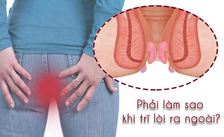 Phẫu thuật cắt búi trĩ và 2 phương pháp phổ biến