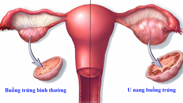 Phẫu thuật cắt buồng trứng có thai được không?