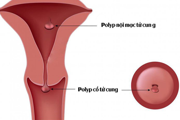 Phẫu thuật cắt polyp cổ tử cung hết bao nhiêu tiền?