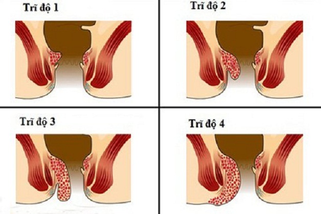 Phẫu thuật cắt trĩ nội độ 3: có thực sự cần thiết không?