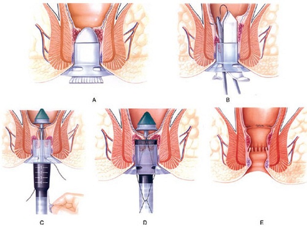 Phẫu thuật cắt trĩ nội độ 3: có thực sự cần thiết không?