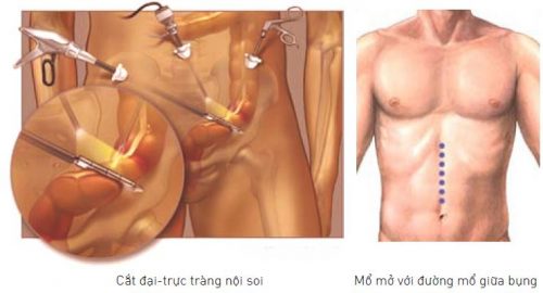 Phẫu thuật cắt trực tràng và những điều cần lưu ý sau