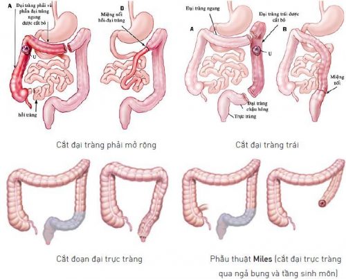 Phẫu thuật cắt trực tràng