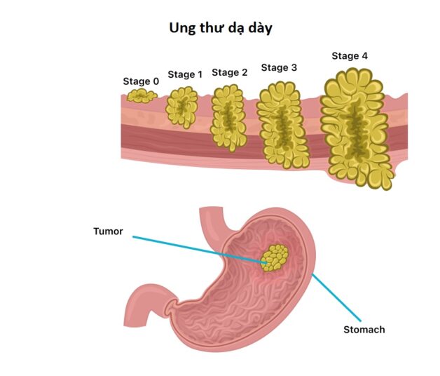 Phẫu thuật cắt ung thư dạ dày có sống được không