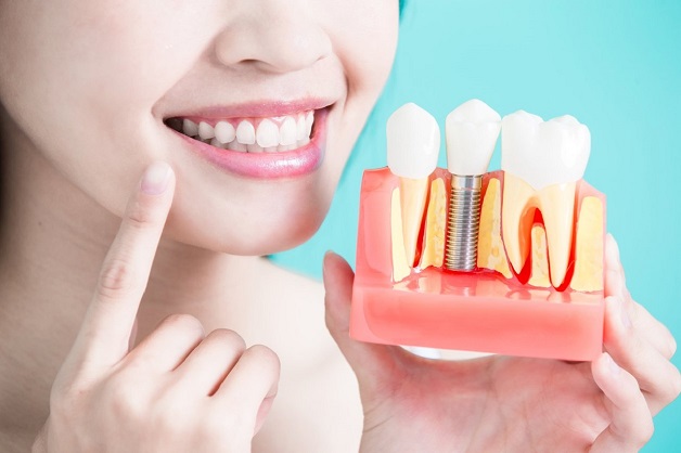 Phẫu thuật cấy ghép implant và những điều cần biết 