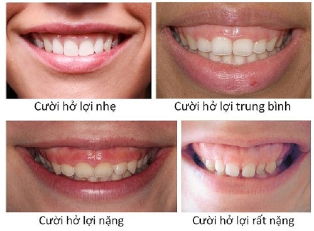 Phẫu thuật cười hở lợi và những điều cần biết 