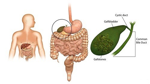 Phẫu thuật điều trị sỏi mật ở Bệnh viện Thu Cúc