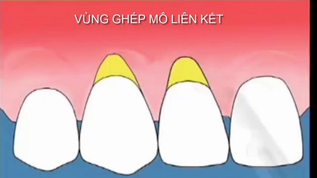 Phẫu thuật ghép lợi và những điều cần biết 