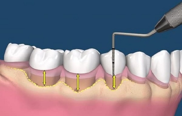 Phẫu thuật ghép vạt lợi và những điều cần biết 