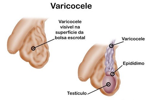 Phẫu thuật giãn tĩnh mạch tinh hoàn