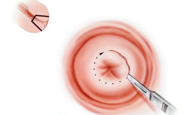 Phẫu thuật khoét chóp cổ tử cung và những điều cần biết