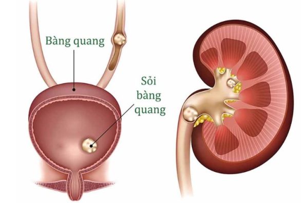 Phẫu thuật lấy sỏi bàng quang khi nào?