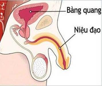 Phẫu thuật lấy sỏi bàng quang khi nào?