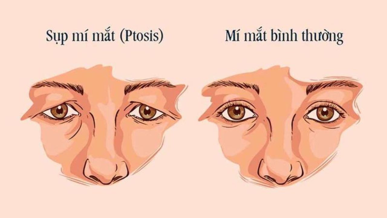 Phẫu thuật mắt sụp mí: Giải pháp hiệu quả cho đôi mắt đẹp