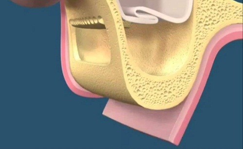 Phẫu thuật nâng xoang hở cấy ghép implant diễn ra đơn giản