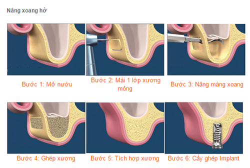 Phẫu thuật nâng xoang hở cấy ghép implant diễn ra đơn giản