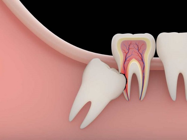 Phẫu thuật nhổ răng khôn an toàn, hiệu quả tại Thu Cúc TCI