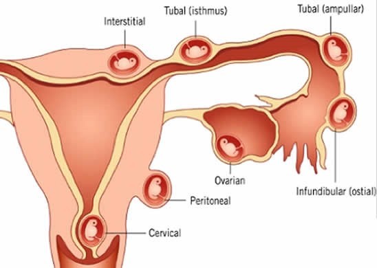 Phẫu thuật nội soi chửa ngoài tử cung bảo toàn khả năng