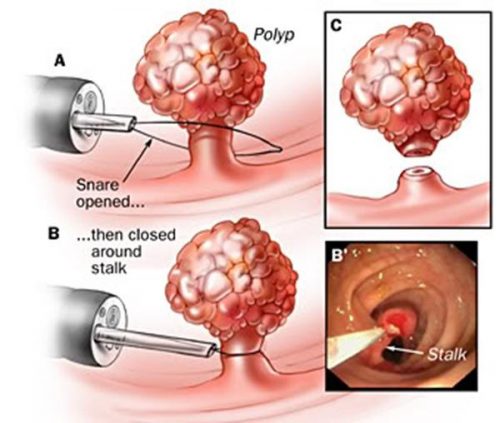 Phẫu thuật polyp trực tràng