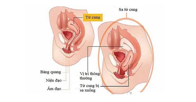 Phẫu thuật sa tử cung có nguy hiểm không?