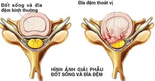 Phẫu thuật thoát vị đĩa đệm và những điều cần biết