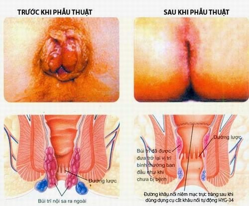 Phẫu thuật trĩ có đau không?