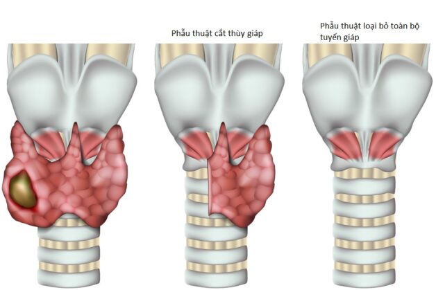 Phẫu thuật trong điều trị ung thư tuyến giáp