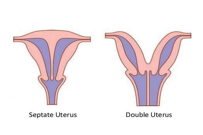 Phẫu thuật tử cung có vách ngăn là như thế nào?