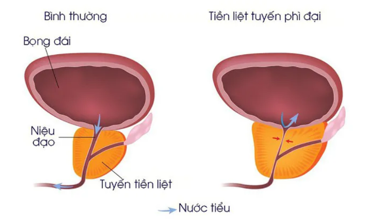 Phẫu thuật u xơ tuyến tiền liệt – chấm dứt “nỗi đau khổ” cho quý ông