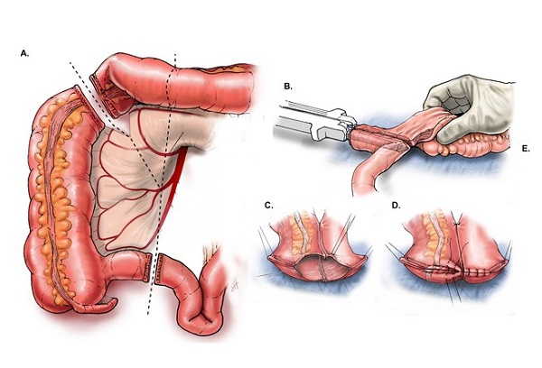 Phẫu thuật ung thư đại tràng