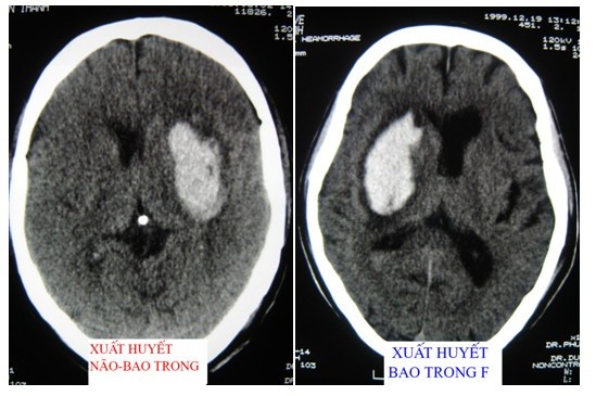 Phẫu thuật xuất huyết não có hiệu quả không?