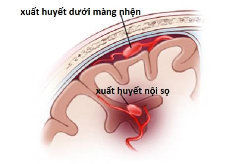 Phẫu thuật xuất huyết não có hiệu quả không?