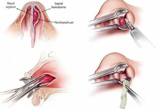 Phì đại cuốn mũi – Bệnh lý phổ biến ai cũng nên biết